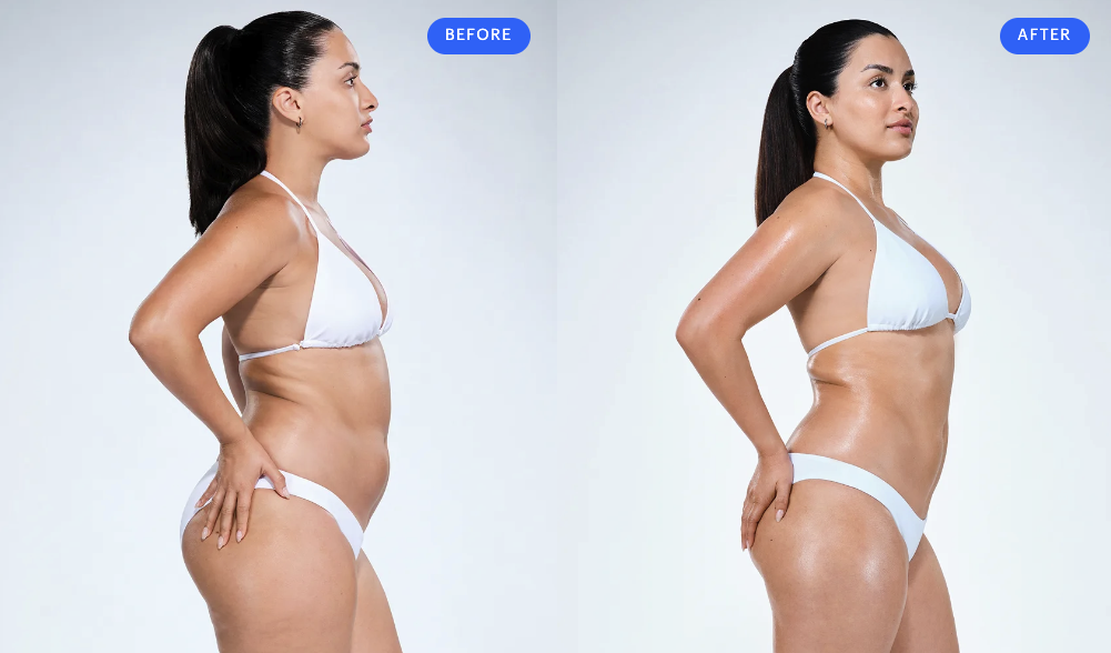 before-and-after-coolscilpting