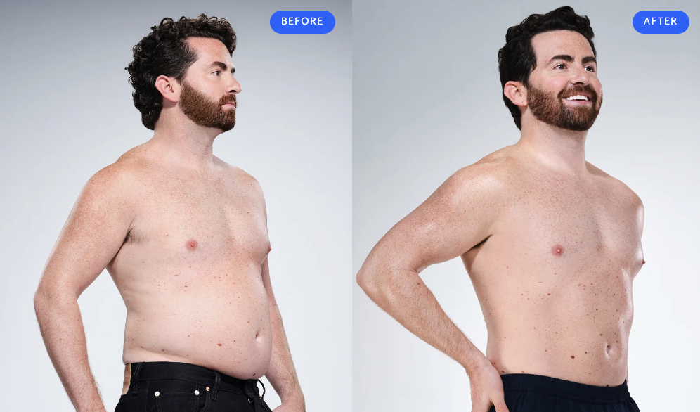 coolsculpting-treatments-before-andafter