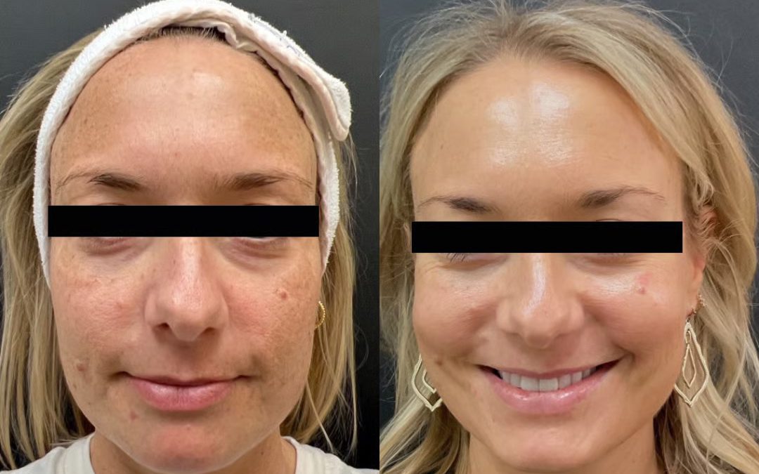 Clear Up Pigmentation Issues With Q-Switch Laser
