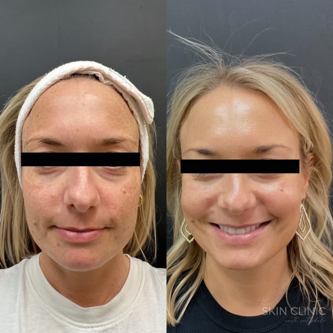 remove-pigmentation-with-qswitch